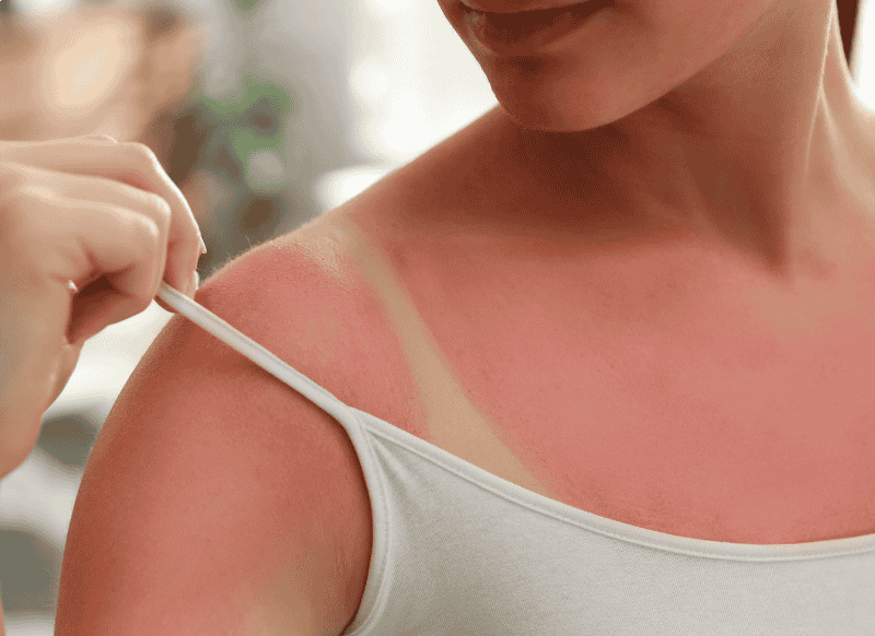 Kas notiek ar mūsu ādu, kad gūstam saules apdegumu? I Kidsmed