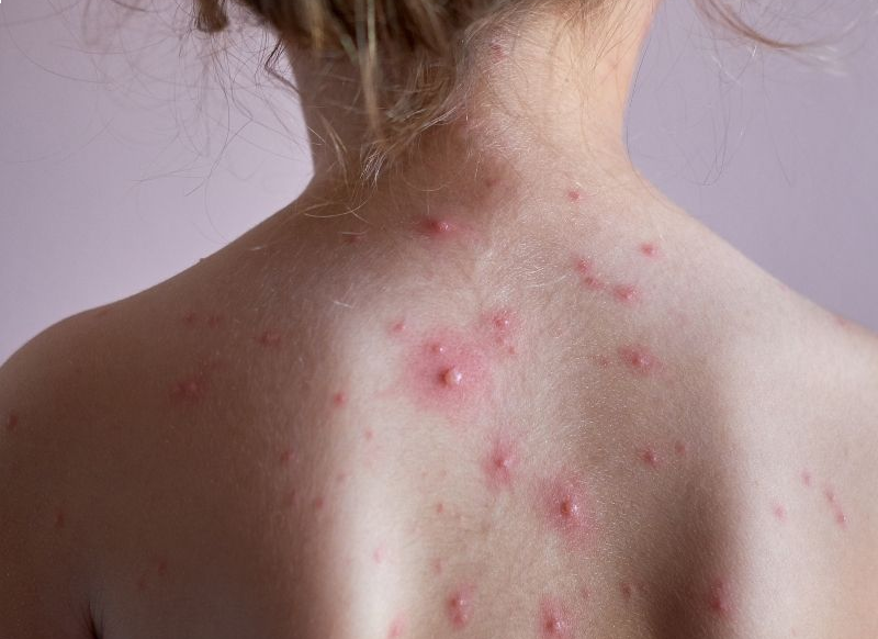 Vējbakas bērniem: simptomi, izplatība un niezes mazināšana | Kidsmed