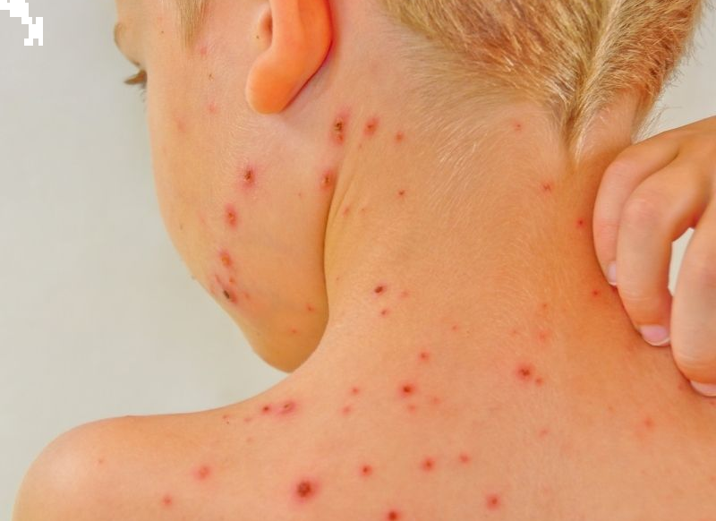 Vējbakas bērnam: ko lietot simptomu mazināšanai un kāds ir kalamīna ieguvums | Kidsmed