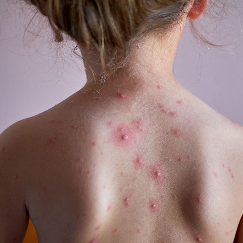 Vējbakas bērniem: simptomi, izplatība un niezes mazināšana | Kidsmed