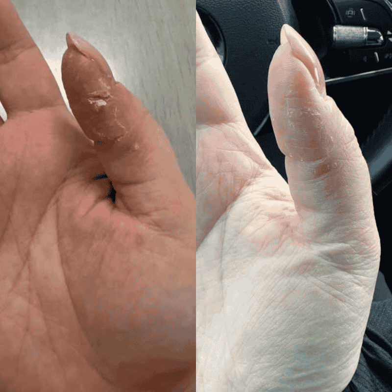 Lietotāja iesūtīts foto ar sausu un kairinātu ādu pirms un pēc kopšanas rutīnas