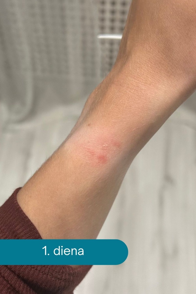 Ovelle_Calamine_kr_ms_sniedz_atvieglojumu_das_kairin_jumiem_1_