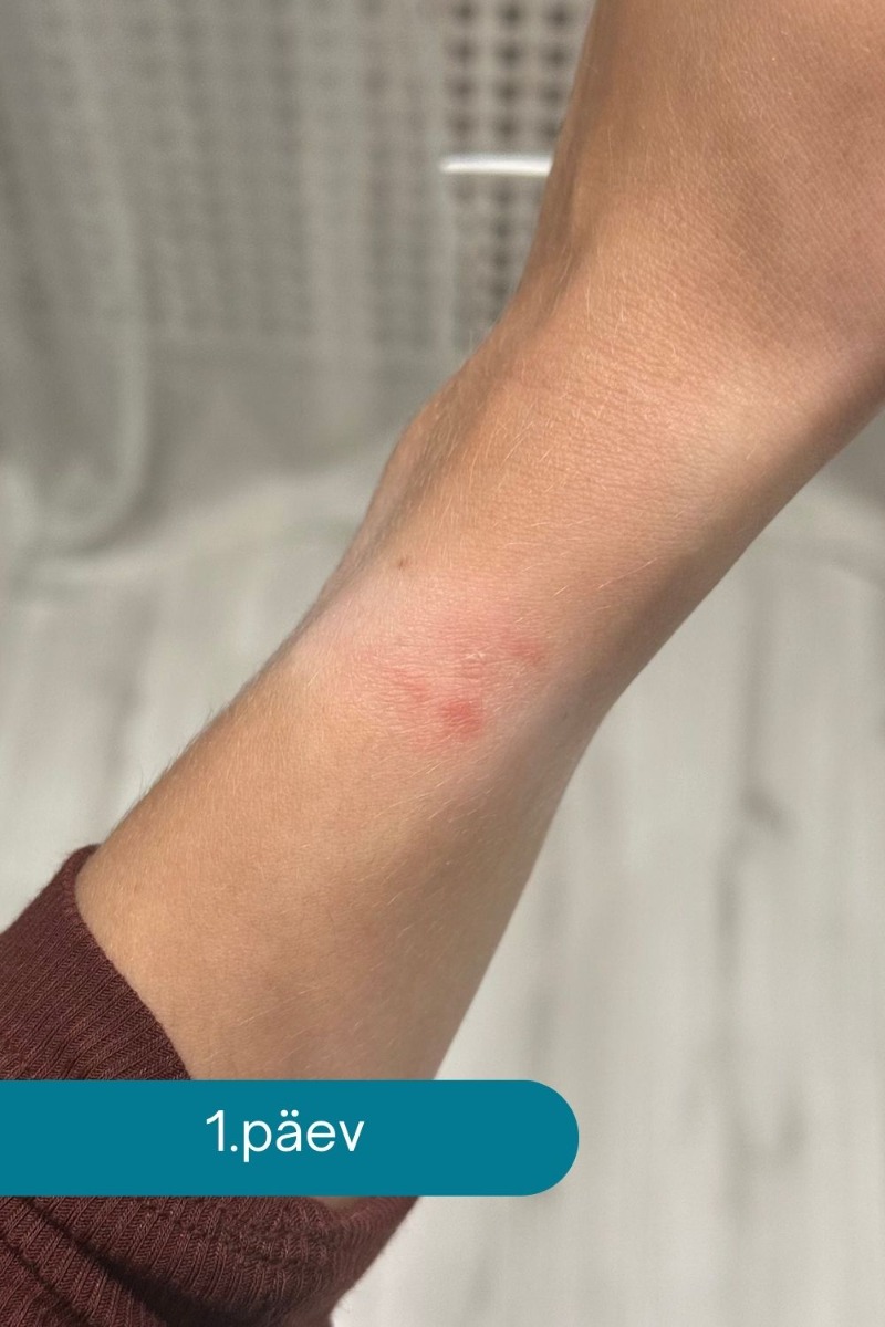 Kalamīna krēms ādas kairinājuma mazināšanai no pulksteņa siksniņas