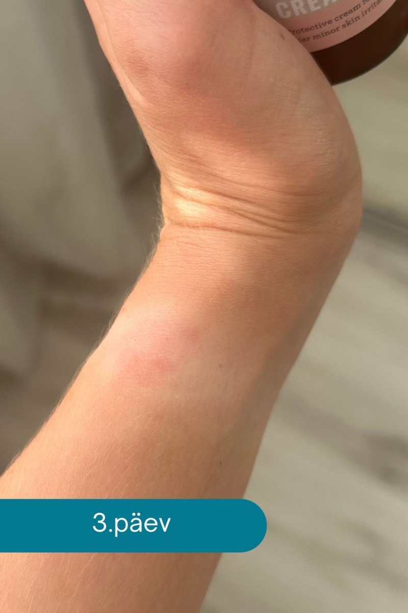 Kalamīna krēms kontaktkairinājuma gadījumā